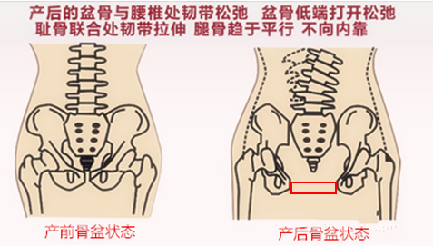 正常骨盆VS产后骨盆