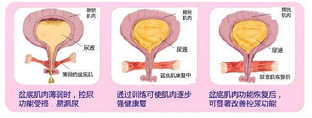 正常盆底肌VS产后盆底肌2